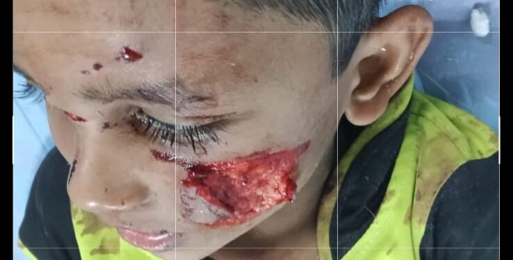 पिसाळलेल्या कुत्राने सहा वर्षे बालकाचा गालाचा लचका तोडला……..